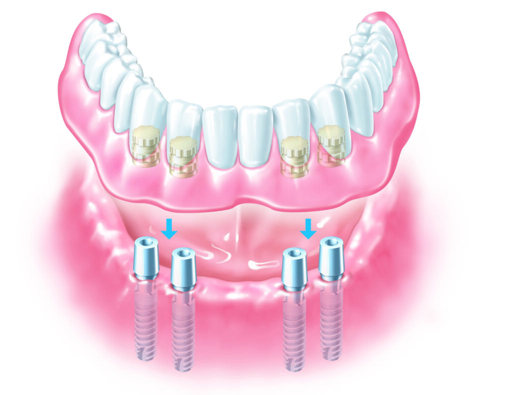 A denture secured with four dental implants